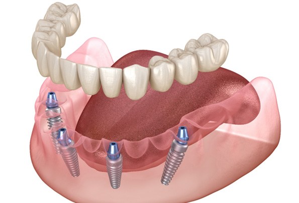 Illustration of All-on-4 dental implants in Everett, WA for lower arch