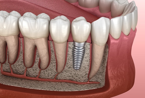 Animation of smile with implant supported replacement tooth