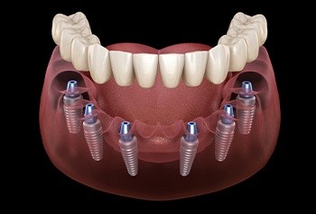 Animated implant supported denture