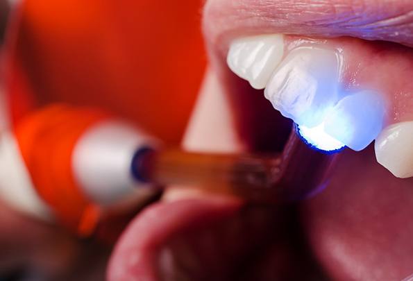 Close up of dental light hardening composite resin