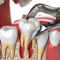 A 3D illustration of a tooth extraction with dental forceps