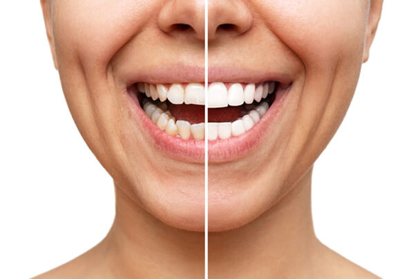 nose-to-chin before/after image of a smile with ad without veneers