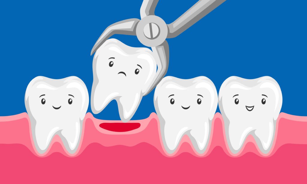 Illustration of a tooth extraction